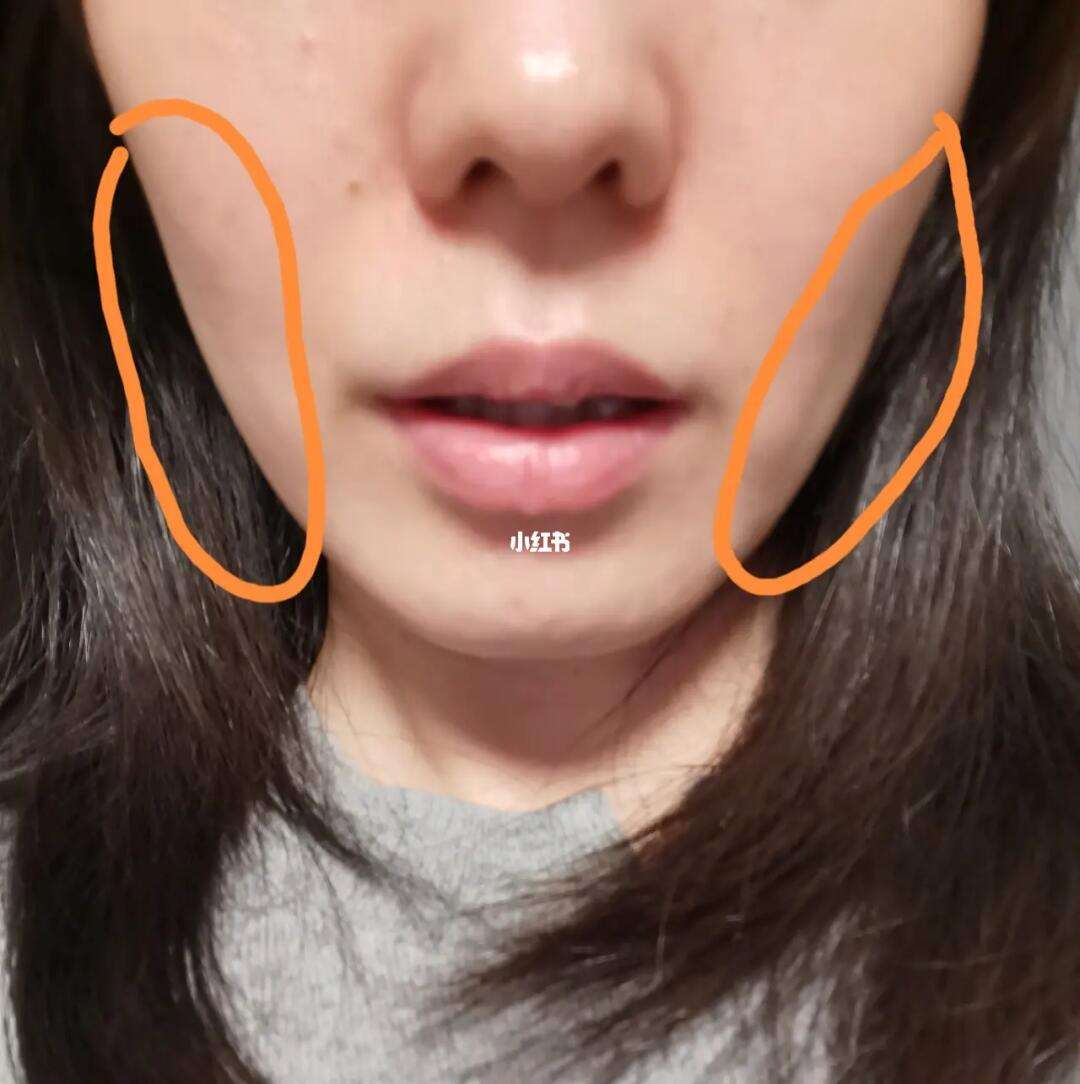 脸凹陷怎么恢复饱满