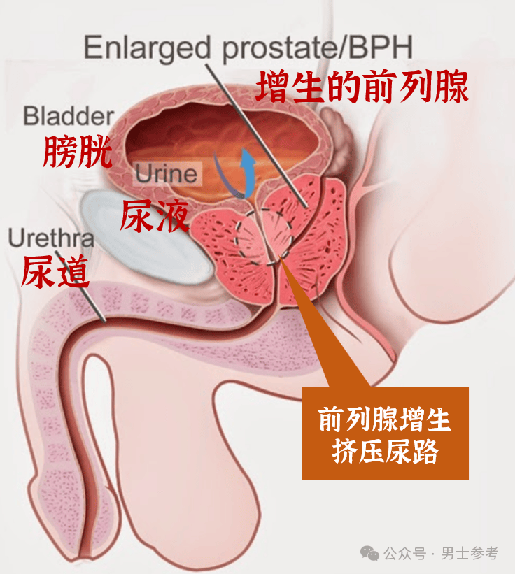 男生前列腺在哪里?有什么特点图片